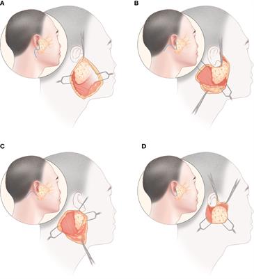 Comparison of various surgical incisions in parotidectomy: A systematic review and network meta-analysis